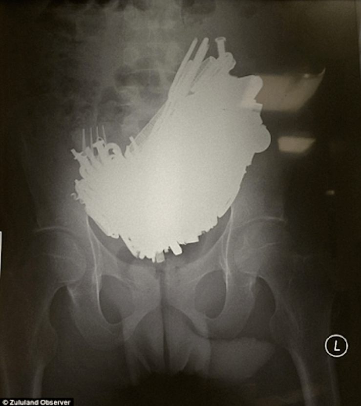 Abdominal X-Ray of a South African man who consumed 227 metal objects (weighing 4.5lbs) including a screwdriver!